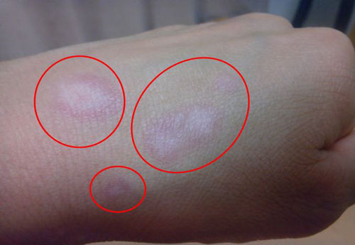 手に使用して肌がまだらに白くなったとされる例